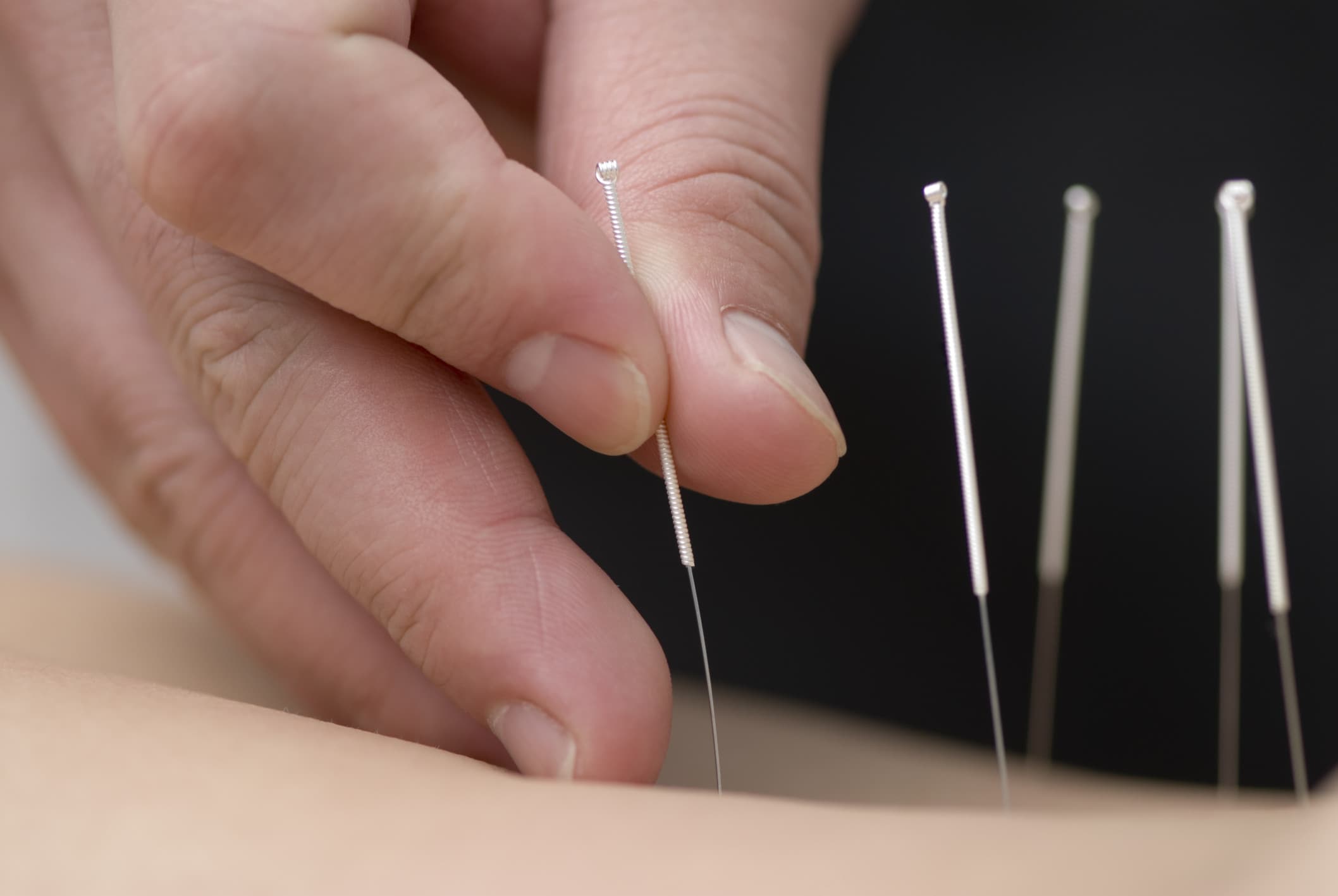 Needle Therapy