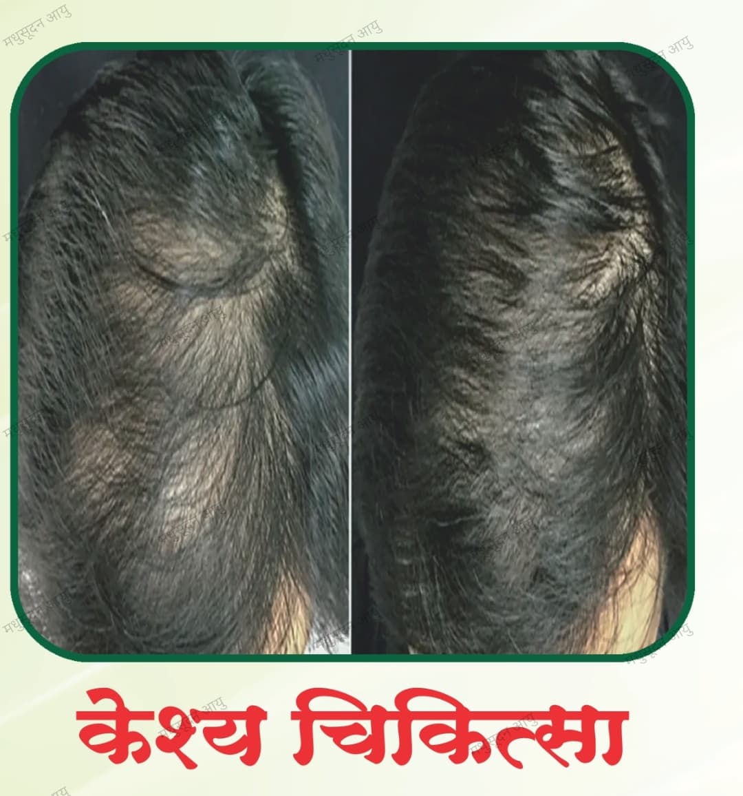 Keshya Therapy: The Ayurvedic Secret to Strong, Healthy & Beautiful Hair